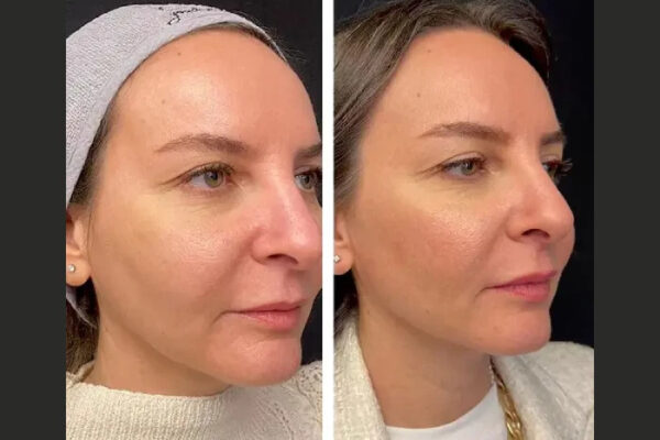 Mesotherapy in dubai
