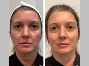 Thread Lift Treatments in Dubai: Before and After Expectations