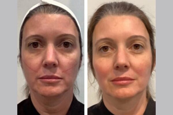 Thread Lift Treatments in Dubai: Before and After Expectations
