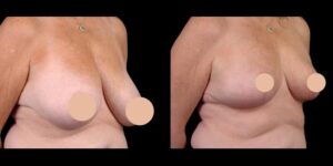 breast reduction in dubai