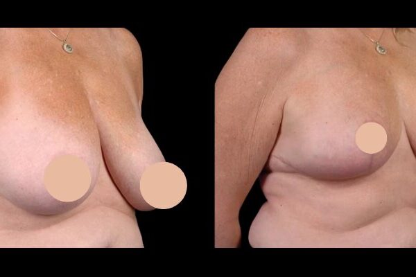 breast reduction in dubai