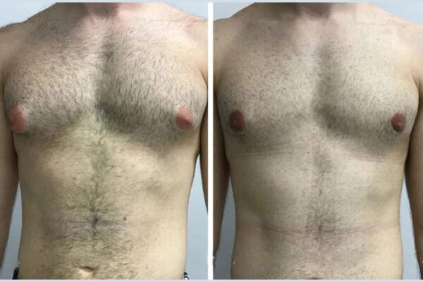 gynecomastia in dubai