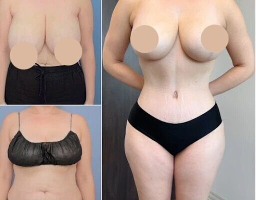 Tummy Tuck in Dubai