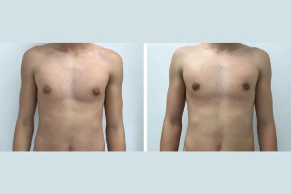 gynecomastia in dubai
