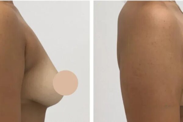 breast lift in dubai