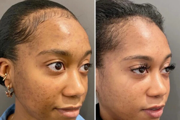 How to Prepare for Your First Chemical Peel Treatment in Dubai