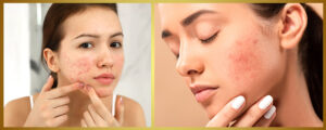 Professional acne treatment in Bourbonnais IL at SF Aesthetic Medspa for clear, glowing skin
