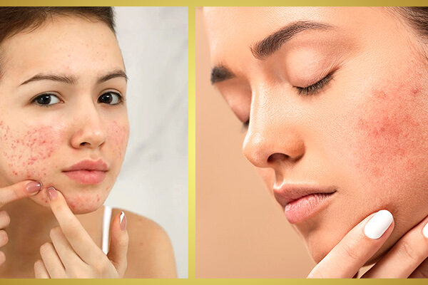 Acne Treatment: Simple Steps to Banish Breakouts Professional acne treatment in Bourbonnais IL at SF Aesthetic Medspa for clear, glowing skin