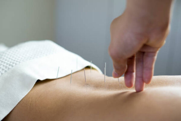 How Can an Acupuncture Clinic Help with Posture and Back Relief? acupuncture clinic